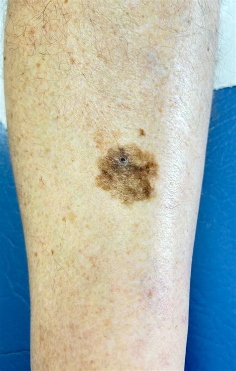 pictures of early melanoma on leg